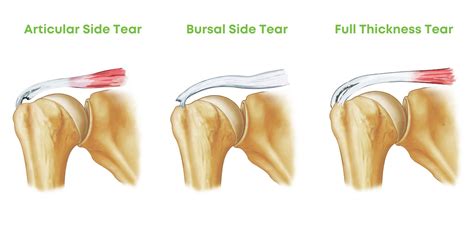 supraspinatus rotator cuff tear test|full thickness tear supraspinatus.